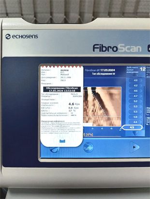 Результаты исследования Fibroscan