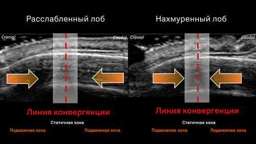 SMAS-лифтинг