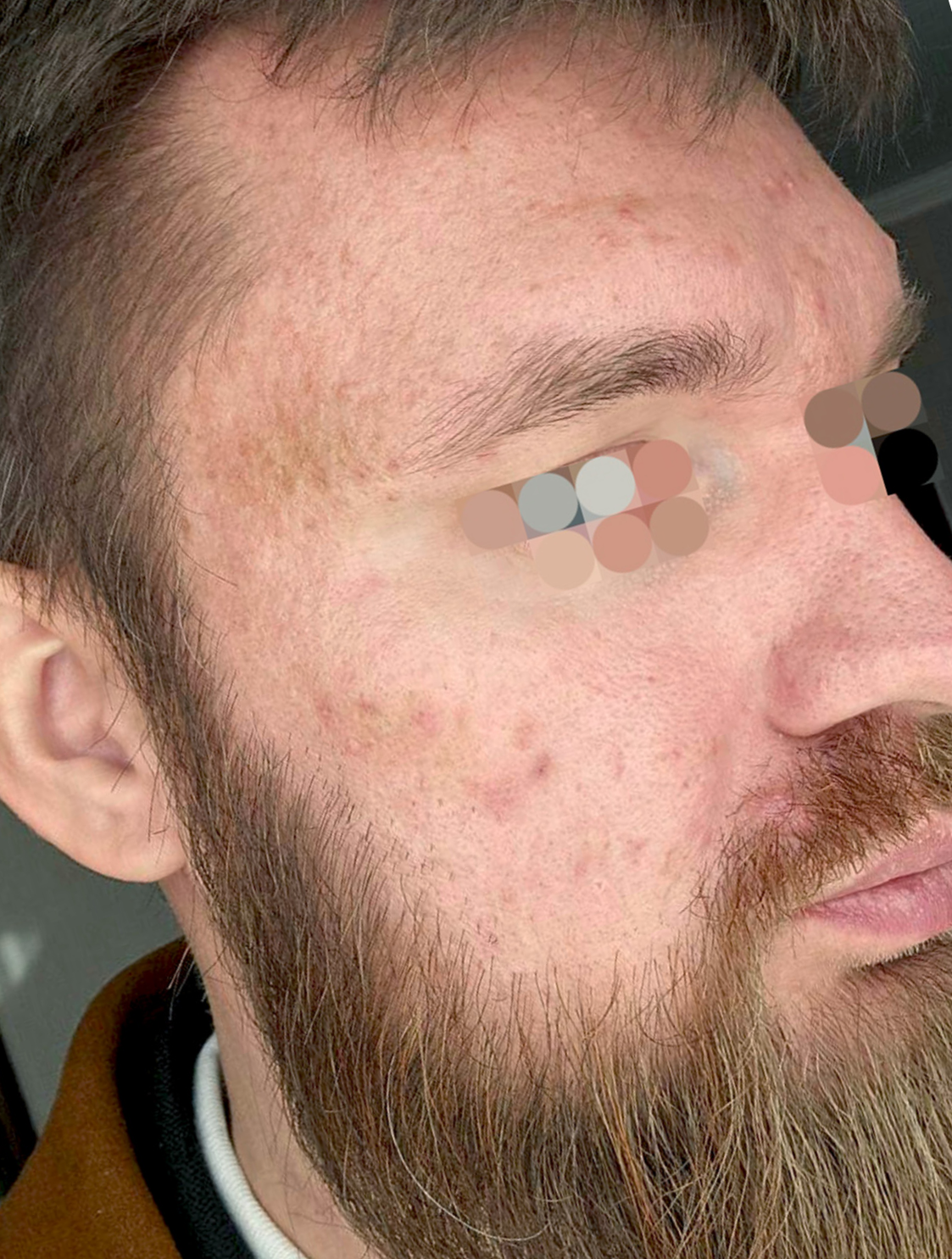 Через 48 часов после IPL-терапиии Clearlight