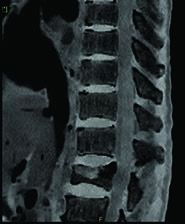 Calcium-suppressed fused