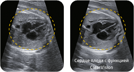 Сердце плода ClearVision