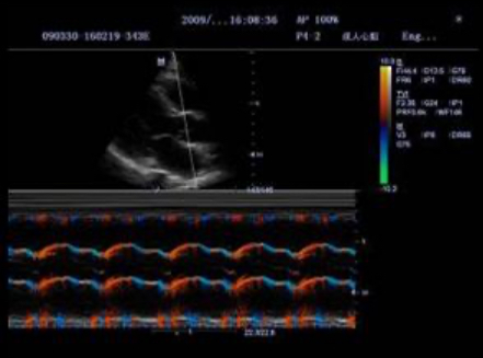 Tissue Doppler Imaging снимок 3