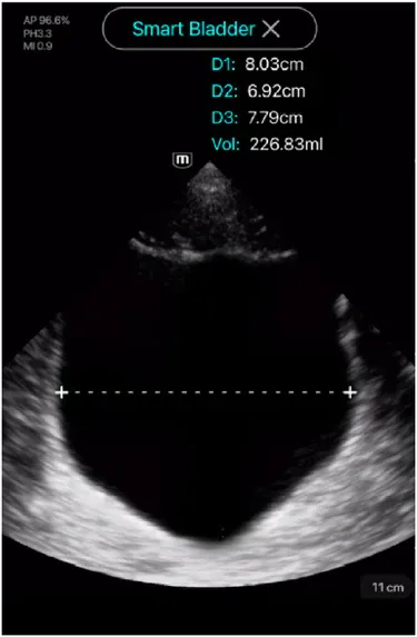 Smart Bladder