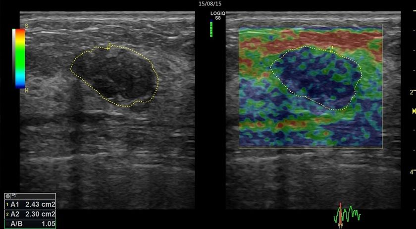 Strain Elastography