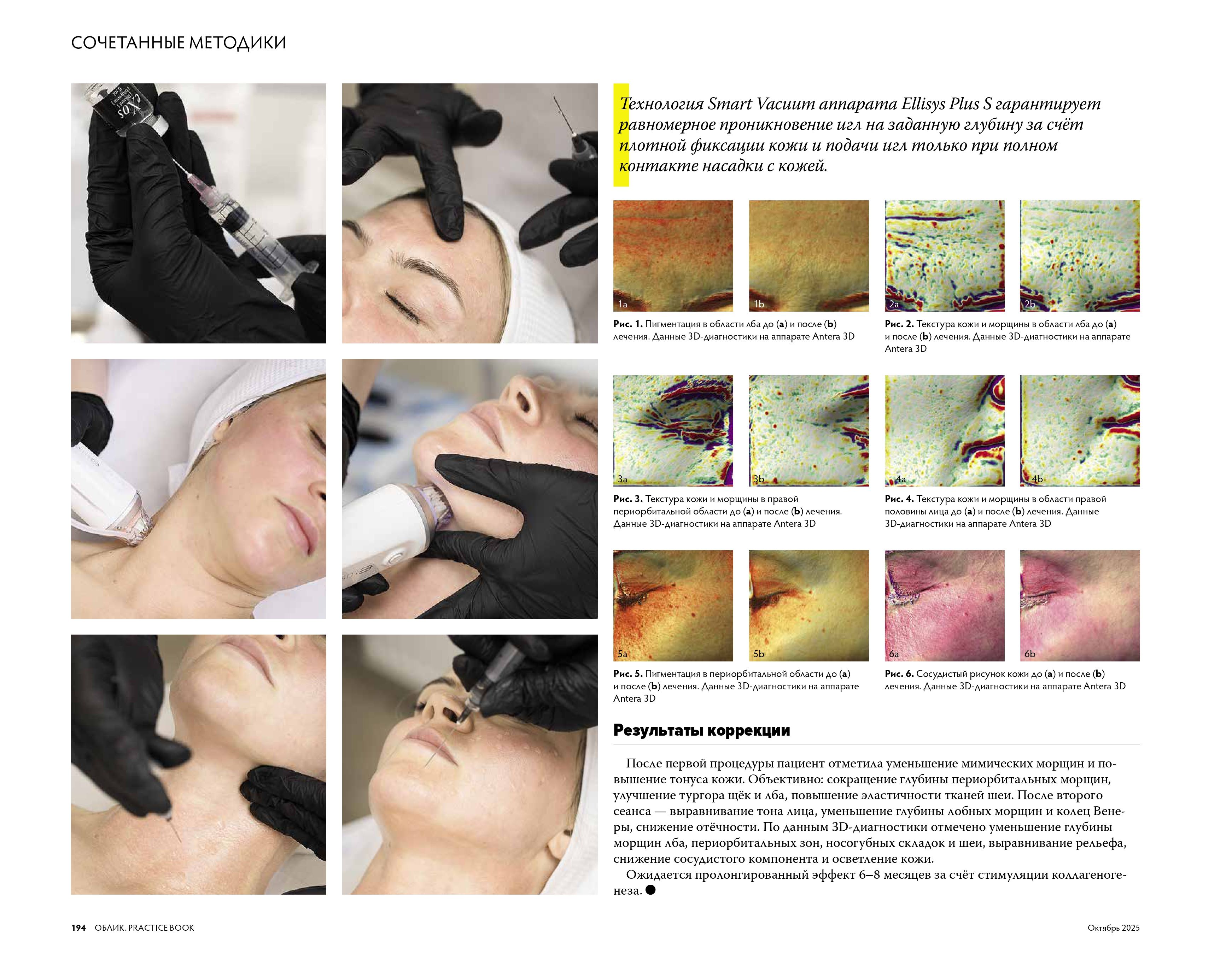 Статья Двойное омоложение кожи: RF-лифтинг + экзосомы страница 4