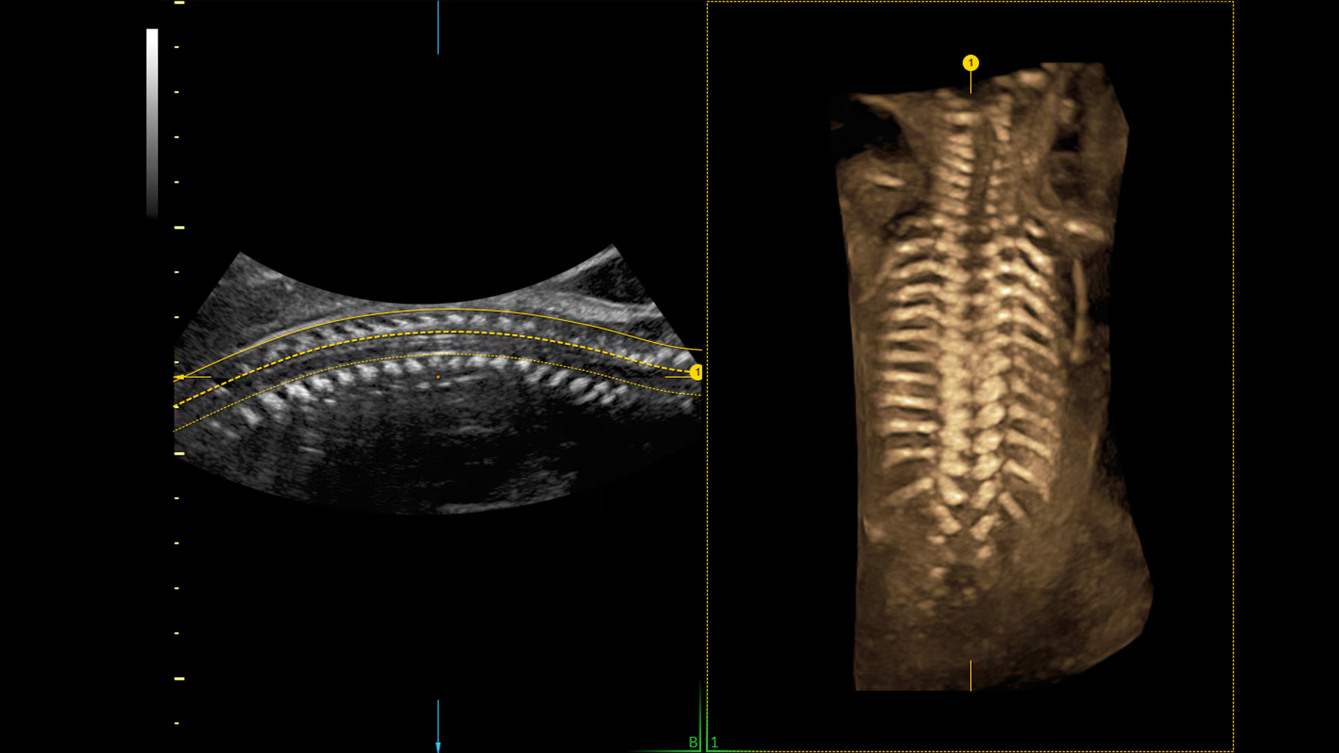 Spine Trace