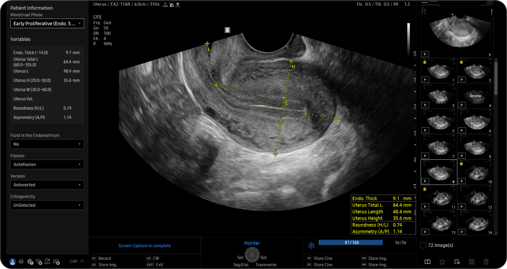 Автоматическая реконструкцию матки