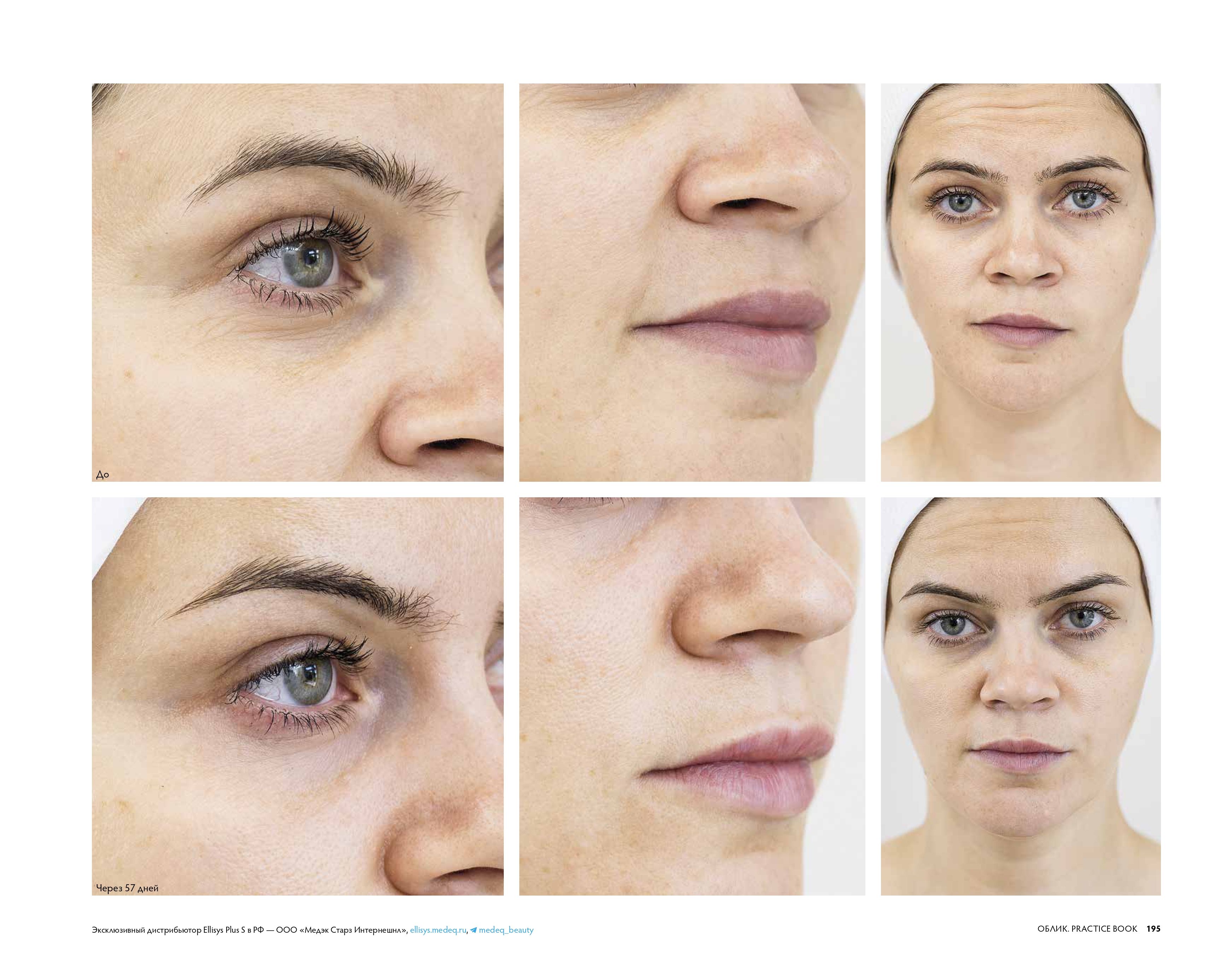 Статья Двойное омоложение кожи: RF-лифтинг + экзосомы страница 5