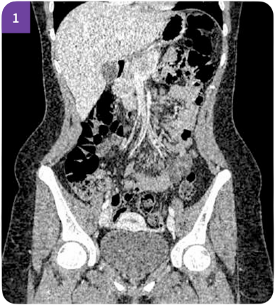 Традиционный метод реконструкции