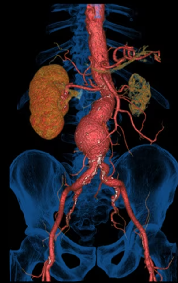Методы реконструкции Томограф Revolution Maxima
