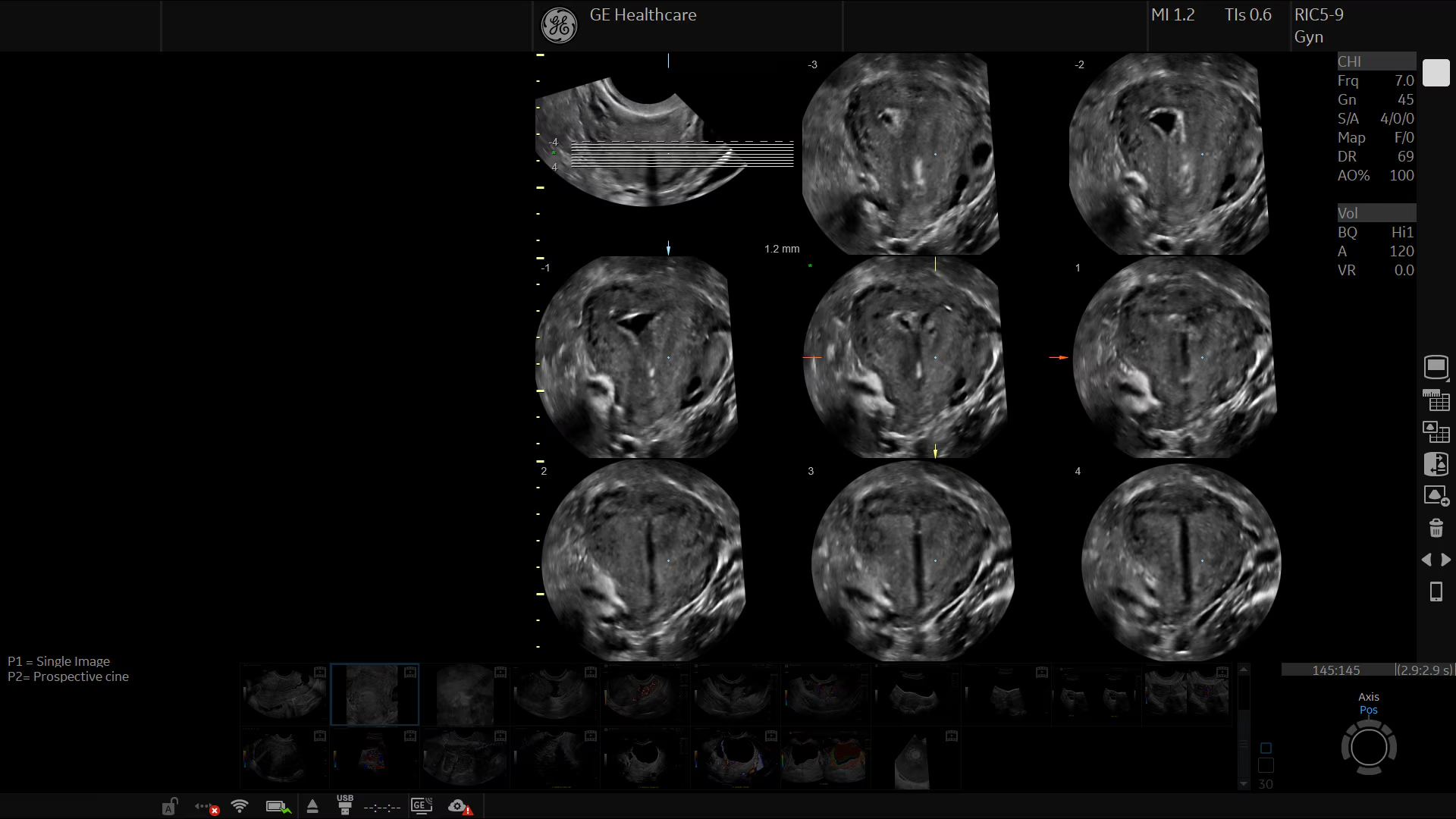 GE Logiq Fortis R4 - 3D TUI матки с внутриматочной спиралью