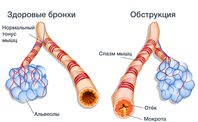 Изображение здоровых бронхов и с обструкцией