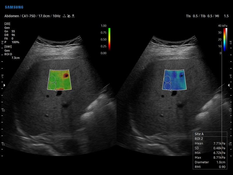 S-Shearwave Imaging