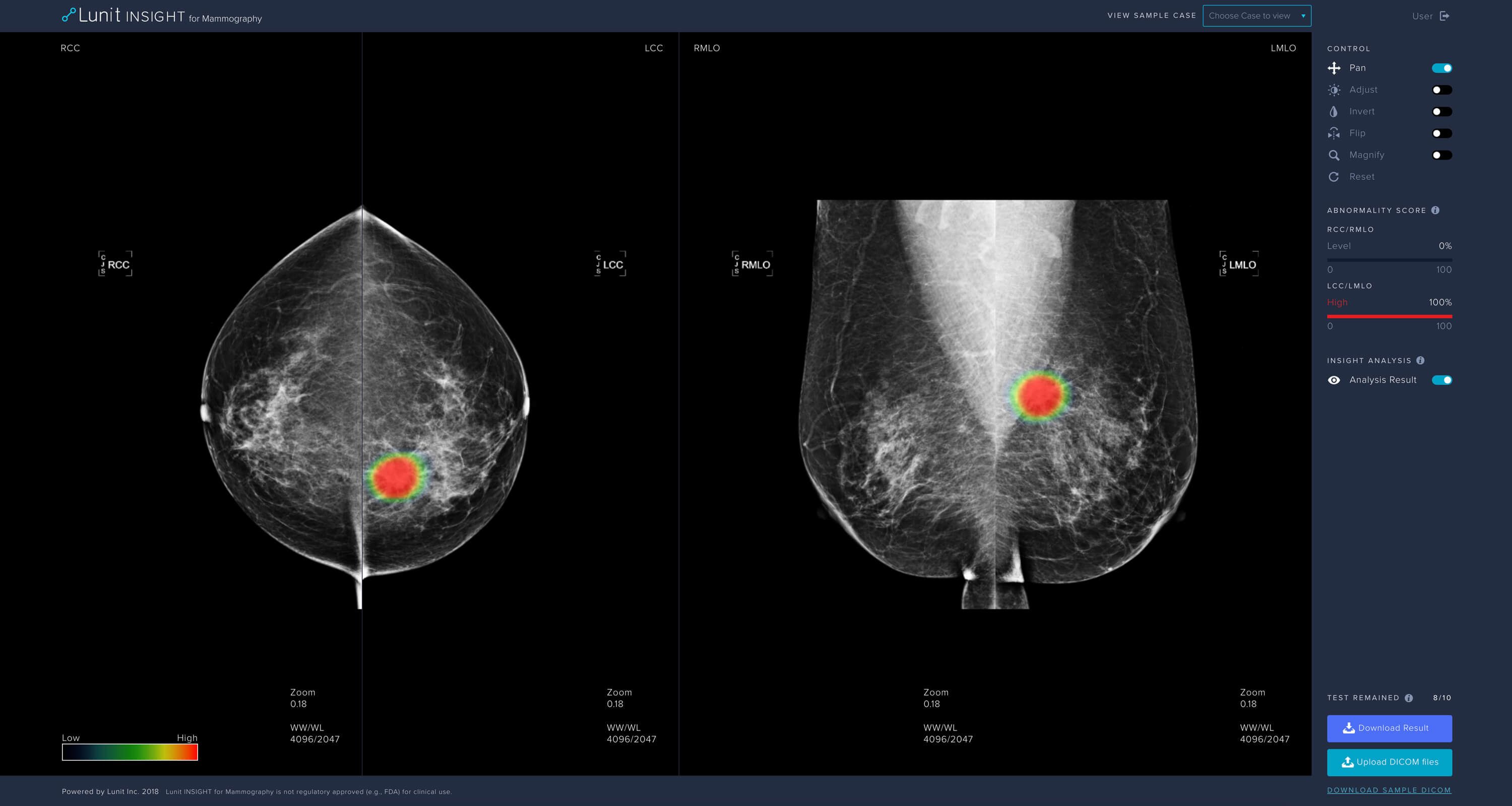 Искусственный интеллект в диагностике рака груди