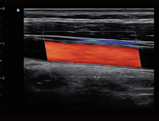 SonoTouch 50 (SonoAir)