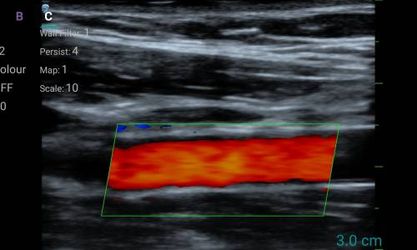 10SE (линейный)