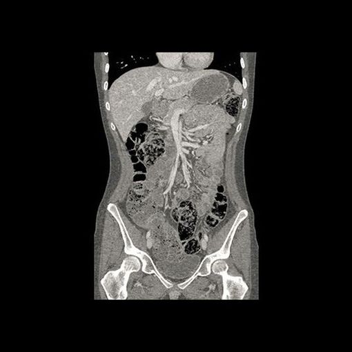 Revolution Discovery CT