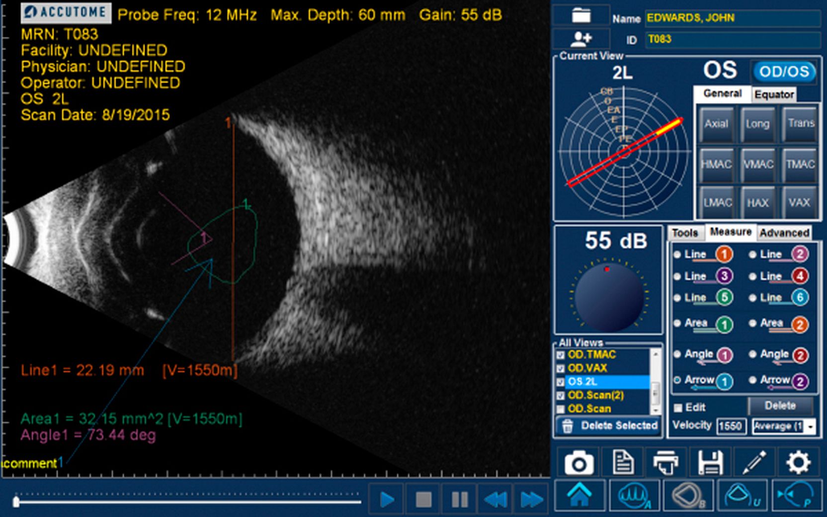 Scan plus. B-scan Plus. 4sight офтальмологическая ультразвуковая система. 4sight Accutome. 4sight офтальмологическая ультразвуковая система Keeler.