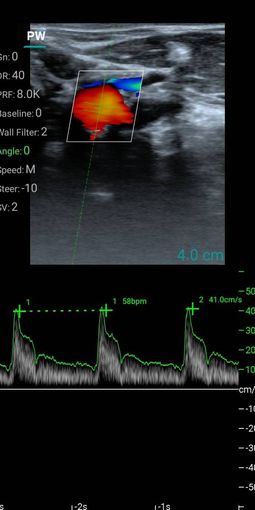 10SE (линейный)