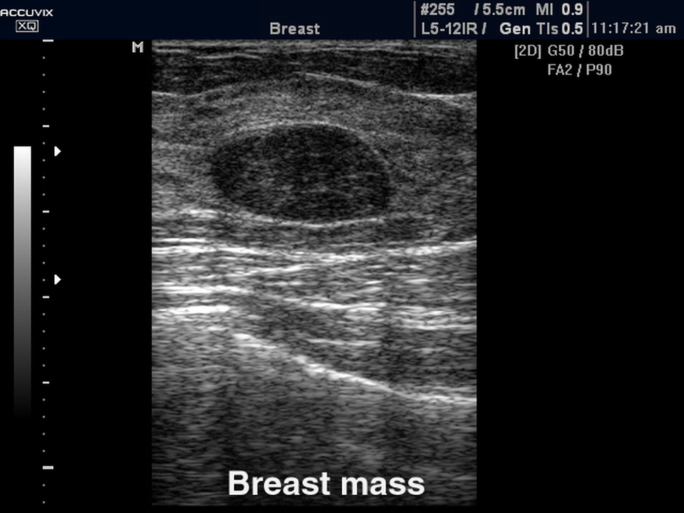 фиброаденома в груди при беременности фото 70
