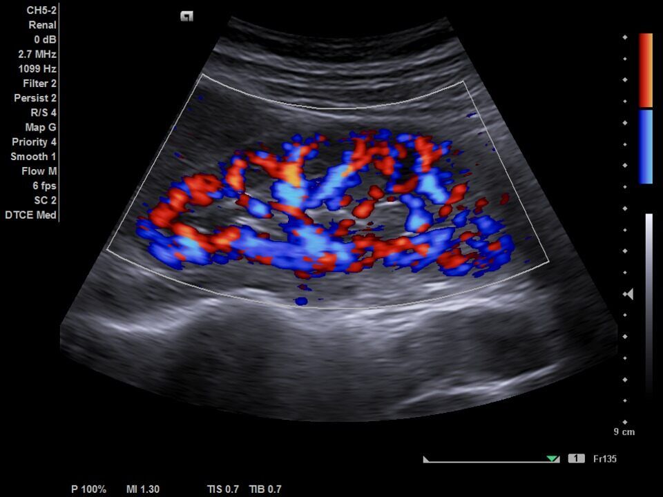 Доплер 2. Siemens Acuson nx2. Допплер сосудов почек. Дуплексное исследование сосудов почек. Допплеровское сканирование почек.