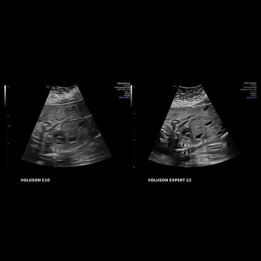 Voluson Expert 22