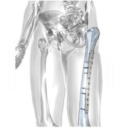 NCB (подборка пластин для полиаксиальной фиксации крупных отломков)