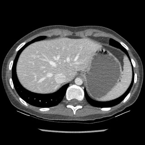 Revolution Discovery CT