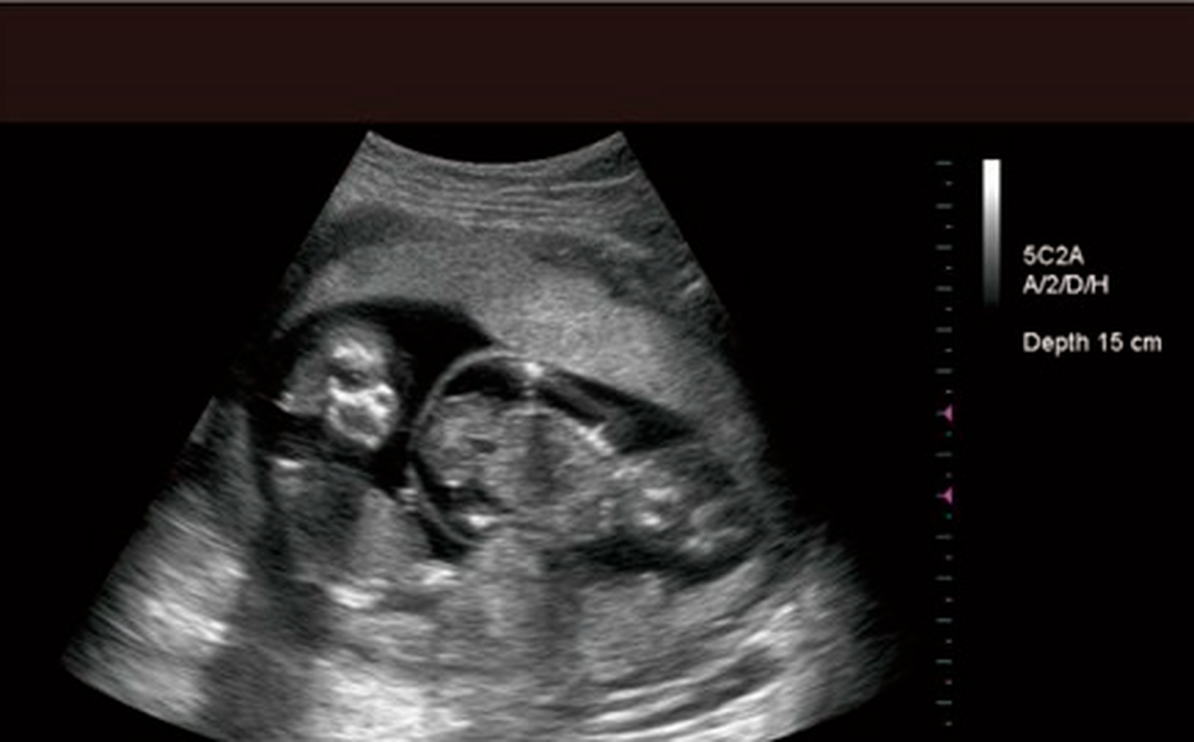 18 неделя близнецов. УЗИ двойняшек на 20 неделе беременности. УЗИ двойни на 20 неделе беременности. Разнояйцевые Близнецы 12 недель УЗИ.