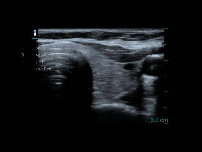 10SE (микроконвексный)