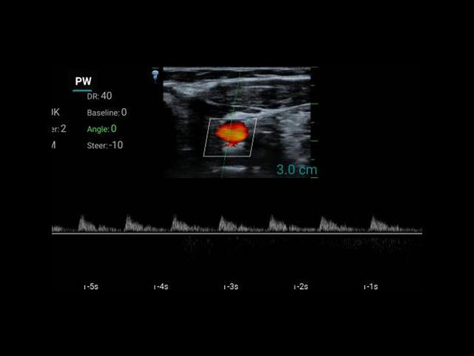 10SE (микроконвексный)
