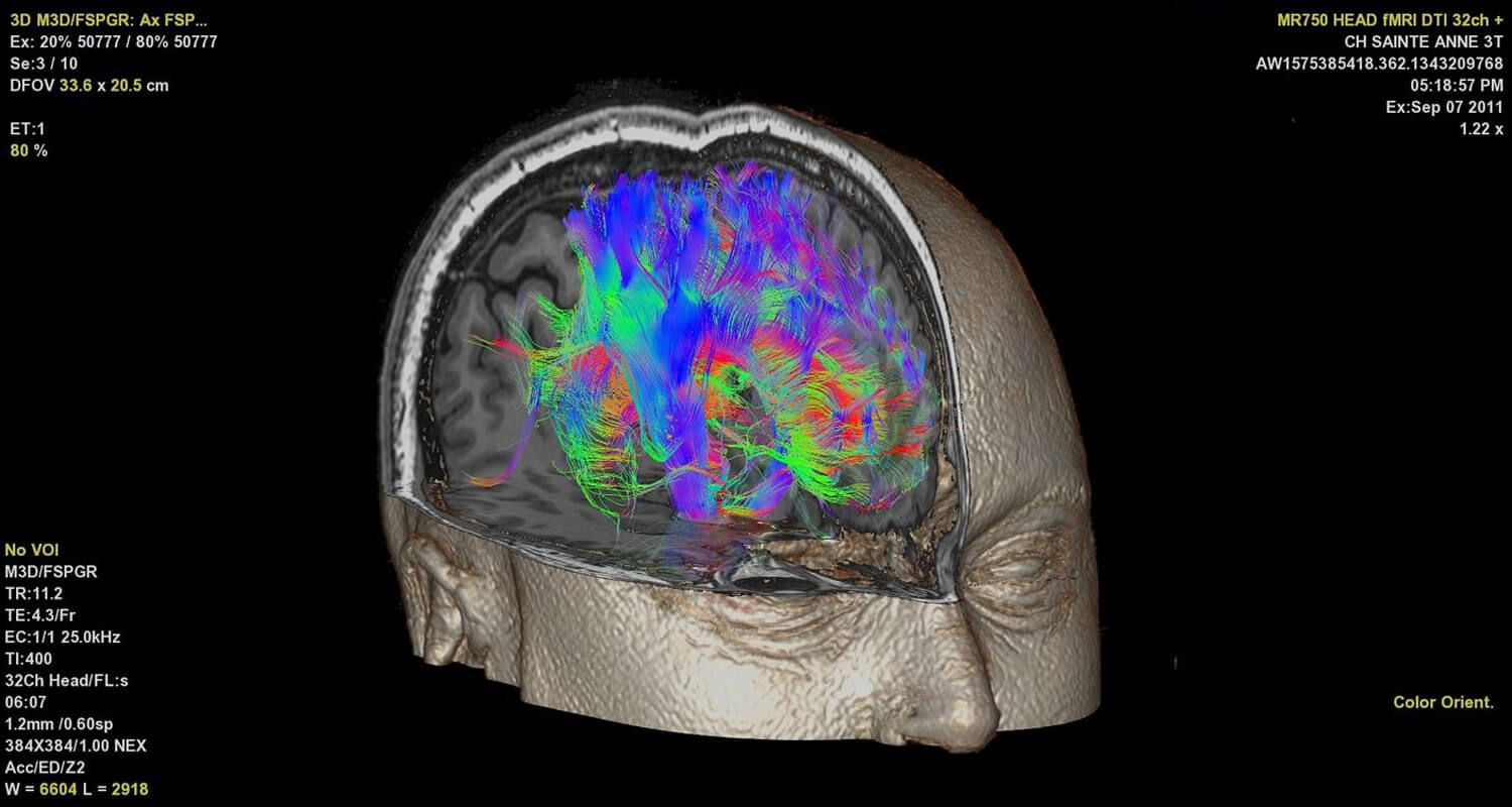 Машинное обучение и МРТ раскрывают тайны головного мозга