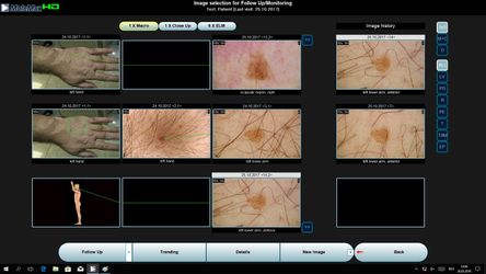 Molemax HD