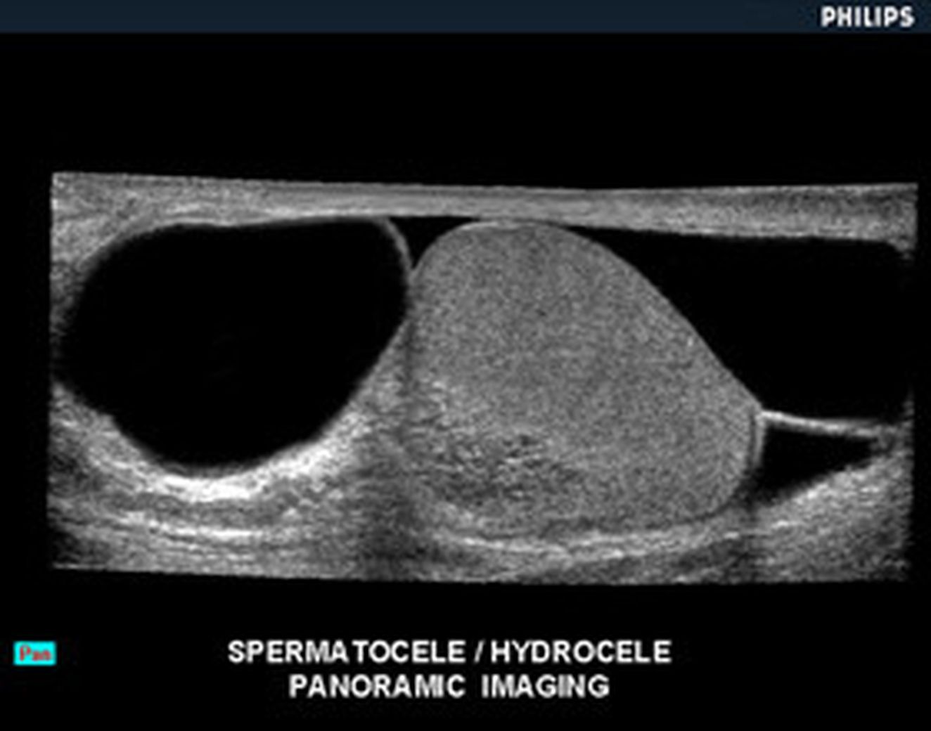 Ультразвуковое исследование сперматоцеле