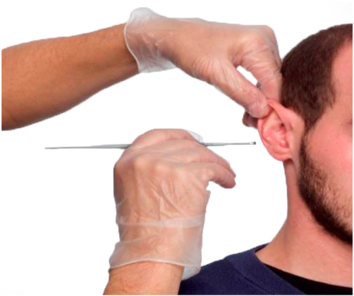 прибор для промывки ушей. промывание среднего уха. промывание ушей от серных пробок. промыть ухо ирригатором. шприц для промывания серных пробок.