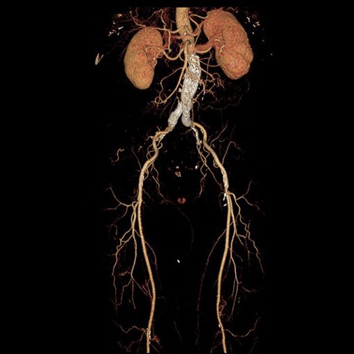 Revolution Discovery CT