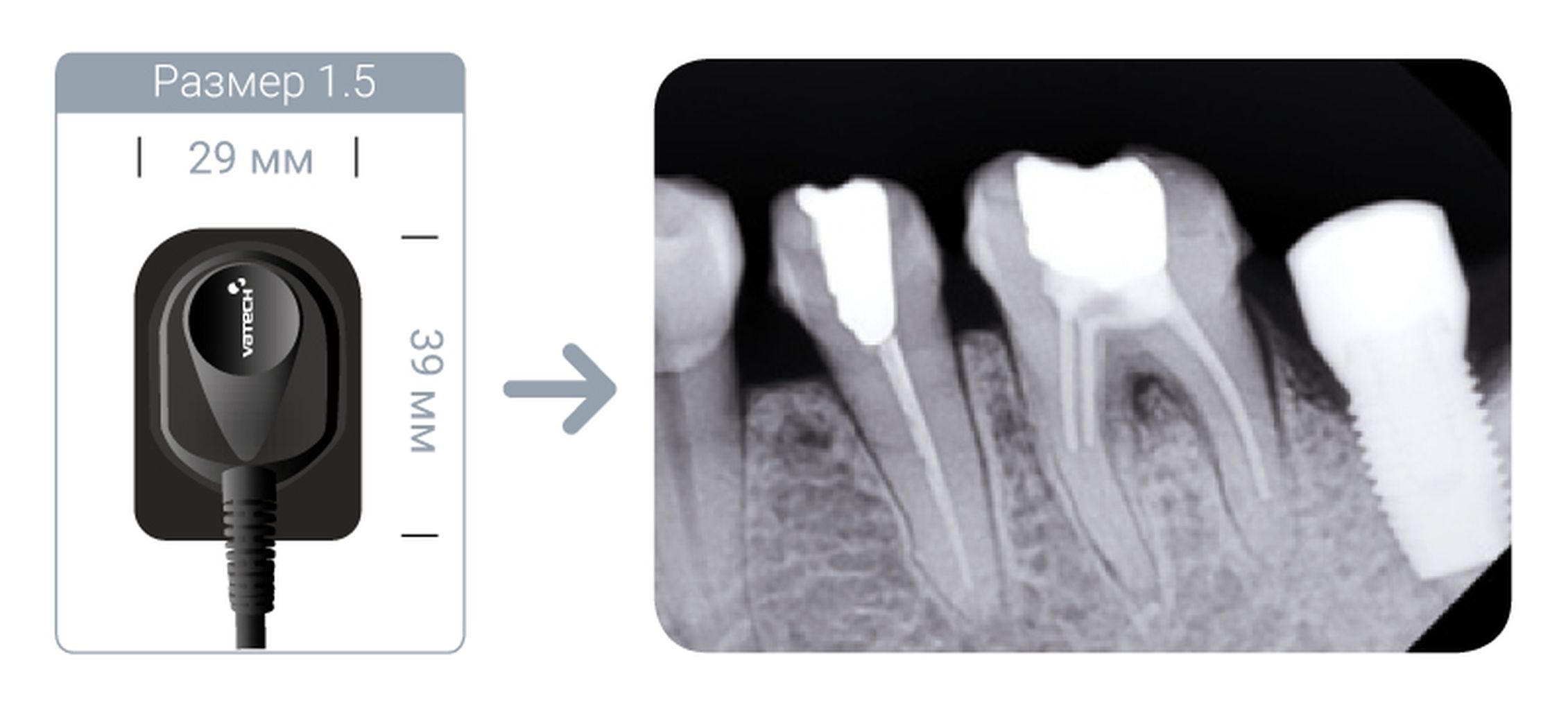 Радиовизиограф vatech. Радиовизиограф VATECH EZSENSOR 1.5. Радиовизиограф VATECH EZSENSOR размер 1.5. Визиограф стоматологический VATECH. Интраоральный визиограф EZSENSOR 1.5.