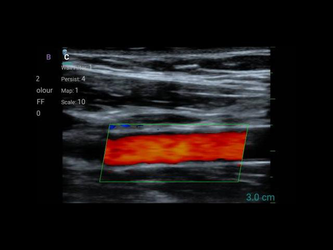 10SE (микроконвексный)
