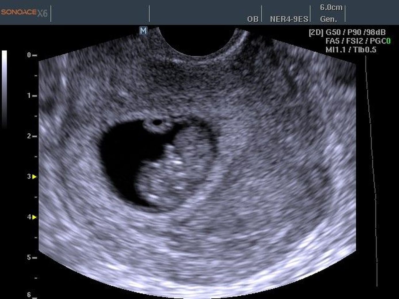 Как выглядит малыш в 6 недель беременности фото