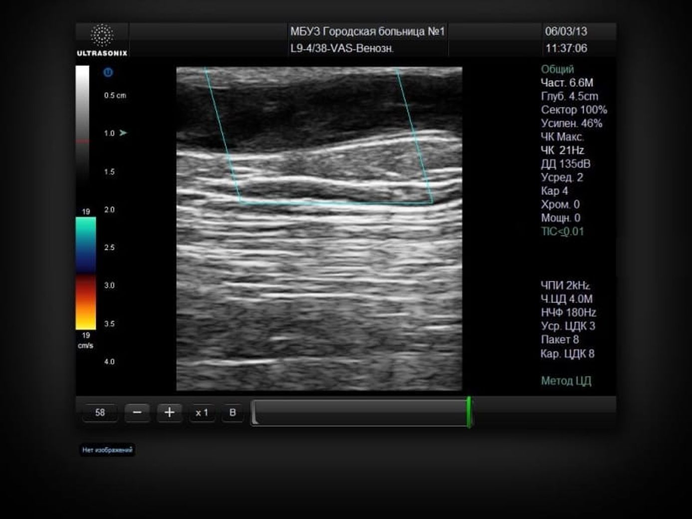 Узи тромбозов. УЗИ Ultrasonix. Тромбофлебит УЗИ заключение. Кнопка кровотока на УЗИ аппарате. Кровоток в режиме ЦДК не лоцируется что это.