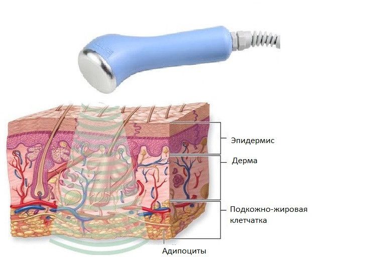 Схема воздействия ультразвука на слои кожи