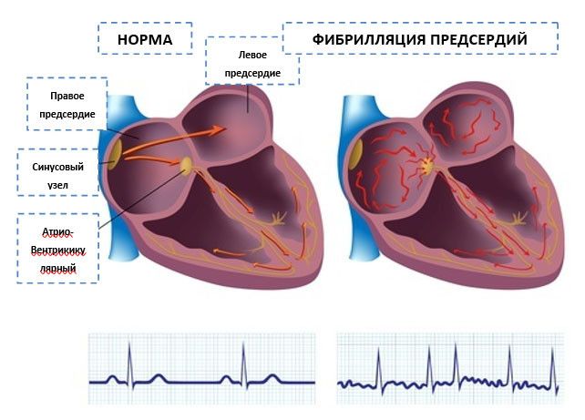 Схема распространения нервных импульсов в норме и при фибрилляции сердца